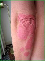 psoriasis